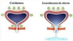 incontinenza urinaria sforzo